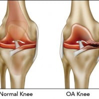 Деформирующий остеоартроз коленного сустава