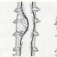 Симптоматика опухоли спинного мозга