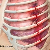 Перелом ребер лечение в домашних условиях