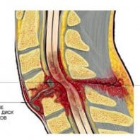 Кровоизлияние в спинной мозг